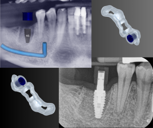 surgical implant planning